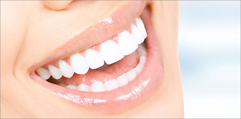 Teeth Whitening